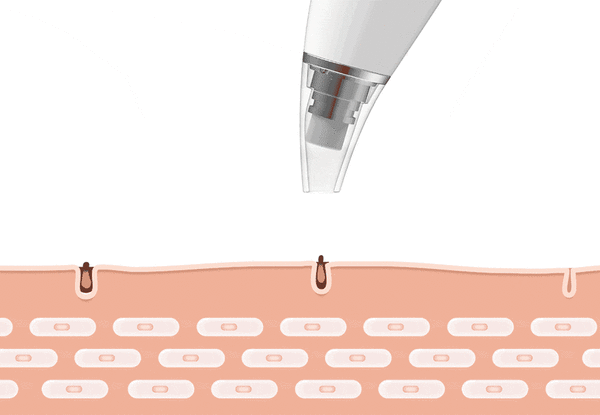 Blackhead Remover Vacuum Pore Cleanser Tool