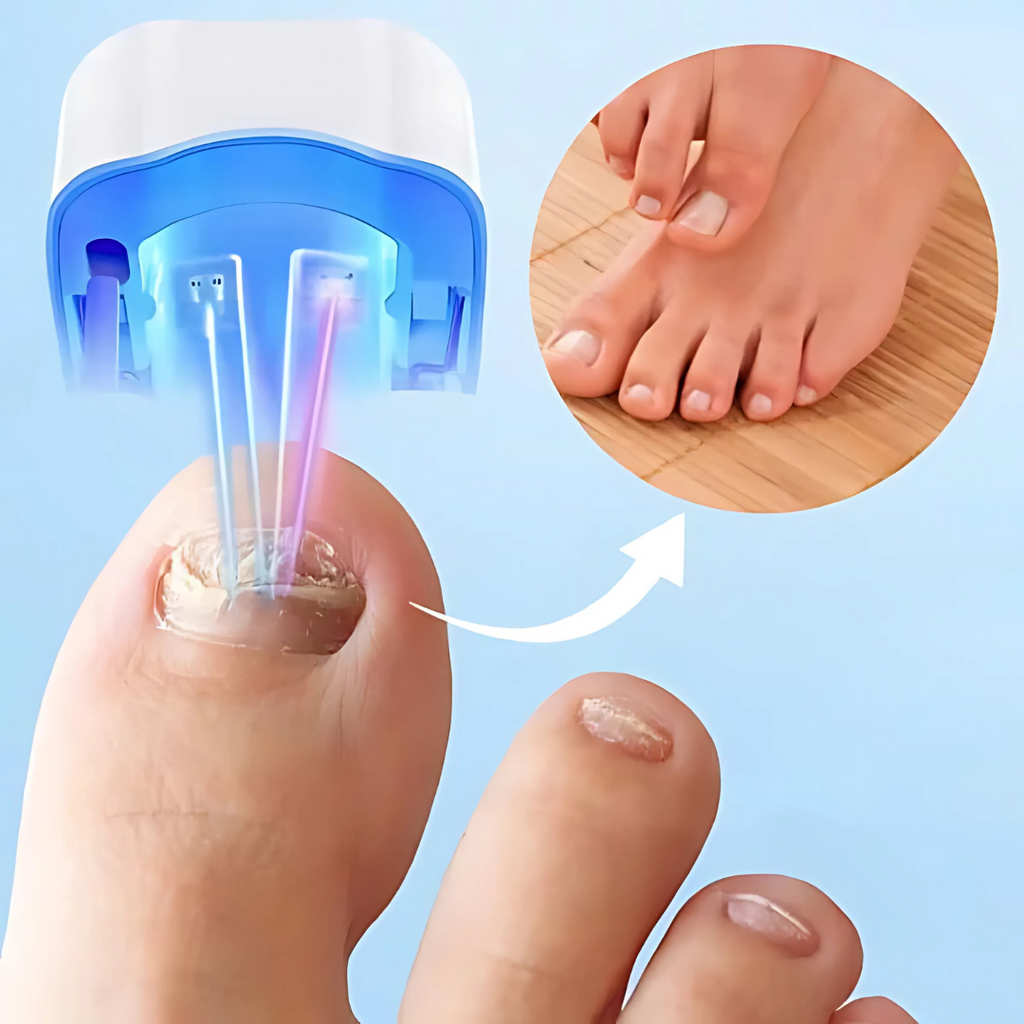 Nail Treatment Laser Device for Fungal Care